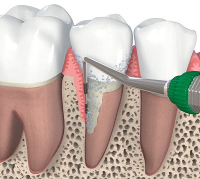 Periodontics in thrissur